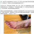 隨州市中心醫(yī)院：八旬老人“老寒腿”獲根治 腰交感神經(jīng)節(jié)射頻消融術(shù)顯奇效